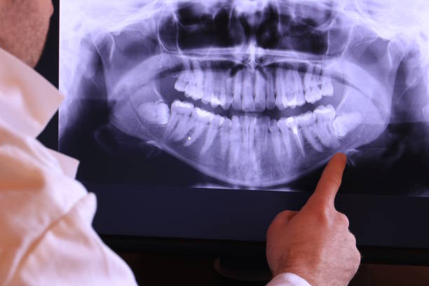 Best Emergency Root Canal Treatment in Lexington, WA