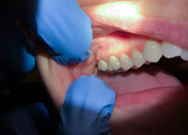 Best Urgent Care for Lost Fillings or Crowns in Lexington, WA
